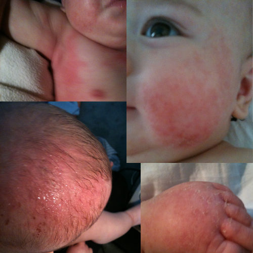 Pictures of eczema skin on baby- red, weeping, angry